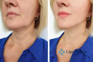 Double chin before and after Hi-Fu treatment 4 Book your double chin treatment Bedfordshire today! We are here to help!