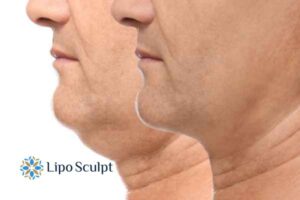 Double chin before and after Hi-Fu treatment 2 Double chin treatment Bedfordshire from Lipo Sculpt - feel more confident today!