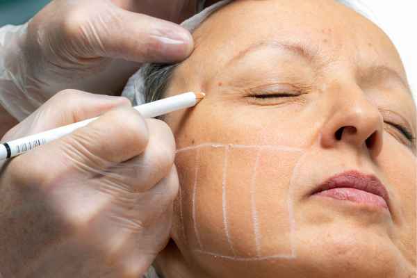 CryoPen: 5 Skin Concerns It May Be Used to Treat 4 What should you ask before having CryoPen treatment Bedfordshire?