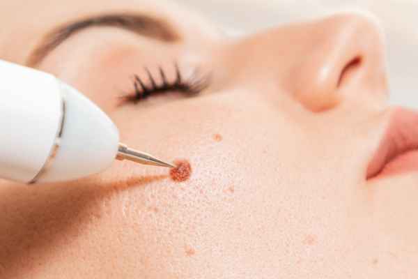 CryoPen: 5 Skin Concerns It May Be Used to Treat 3 What actually happens during a CryoPen treatment Bedfordshire?