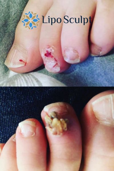 Wart removal customer results from Lipo Sculpt Bedfordshire