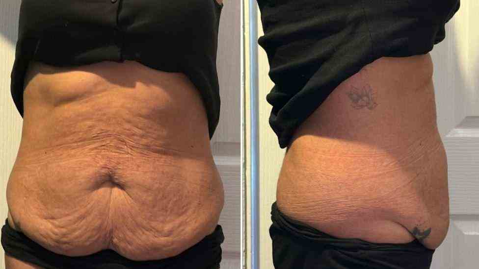 Lost the Weight but Not the Loose Skin? What You Should Know 1 Is It Definitely Loose Skin Bedfordshire?